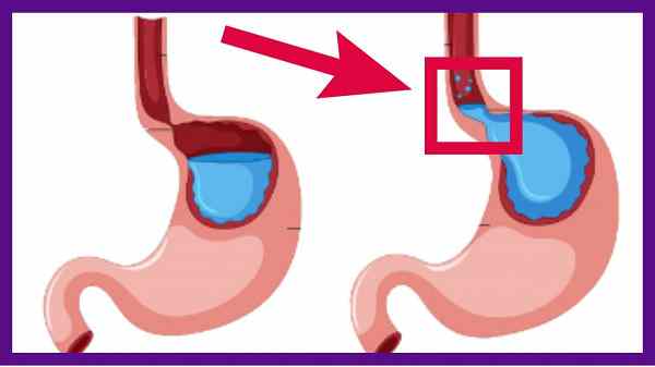 7 ماده غذایی برای کاهش علائم رفلاکس معده