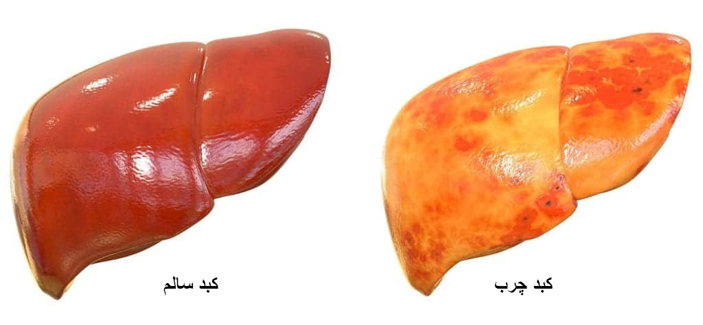 کبد چرب