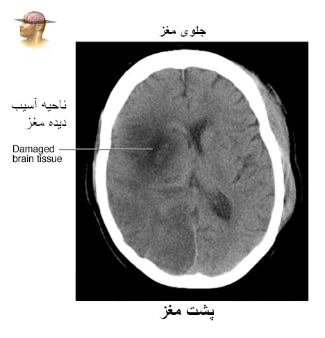 سی تی اسکن مغز آسیب دیده پس از سکته مغزی