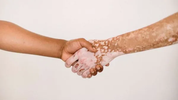 پیشگیری از ویتیلیگو