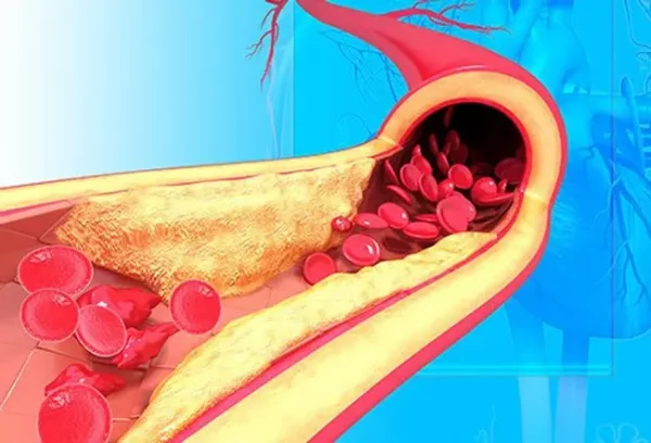 آسیب عروق شریانی ناشی از فشار خون بالا