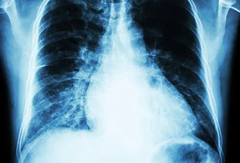 بزرگ شدن قلب ناشی از فشار خون بالا