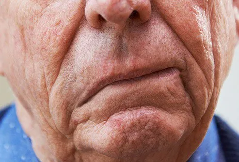 سکته مغزی ناشی از فشار خون بالا