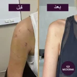 مقایسه قبل و بعد از مصرف ژل ادونسد اسکار مدرما