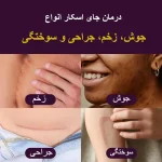 موارد مصرف ژل ادونسد اسکار مدرما